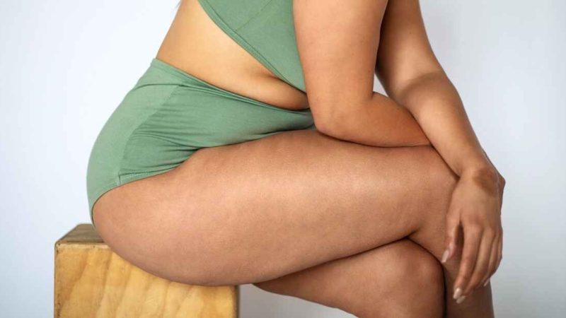 5 choses que personne ne vous a dites sur la cellulite